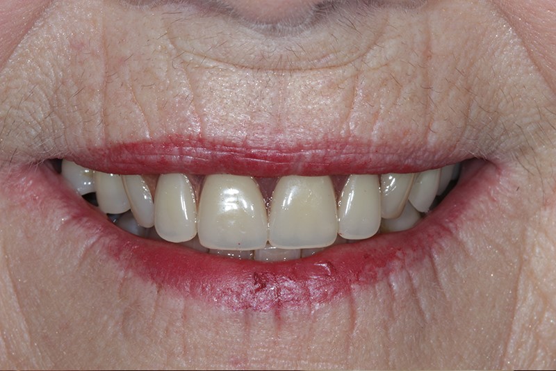 Immediate Dentures Procedure Portland OR 97211